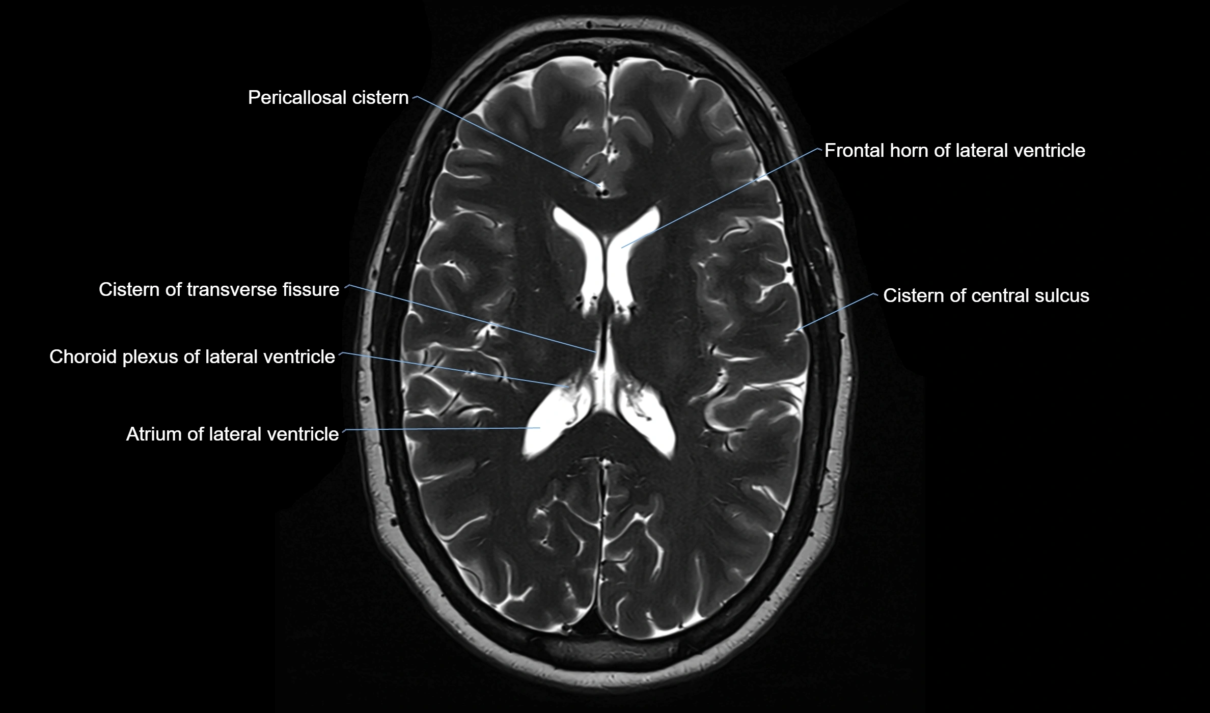 Brain cisterns  and ventricles  axial anatomy 3T MRI image-img-00001-00033.webp